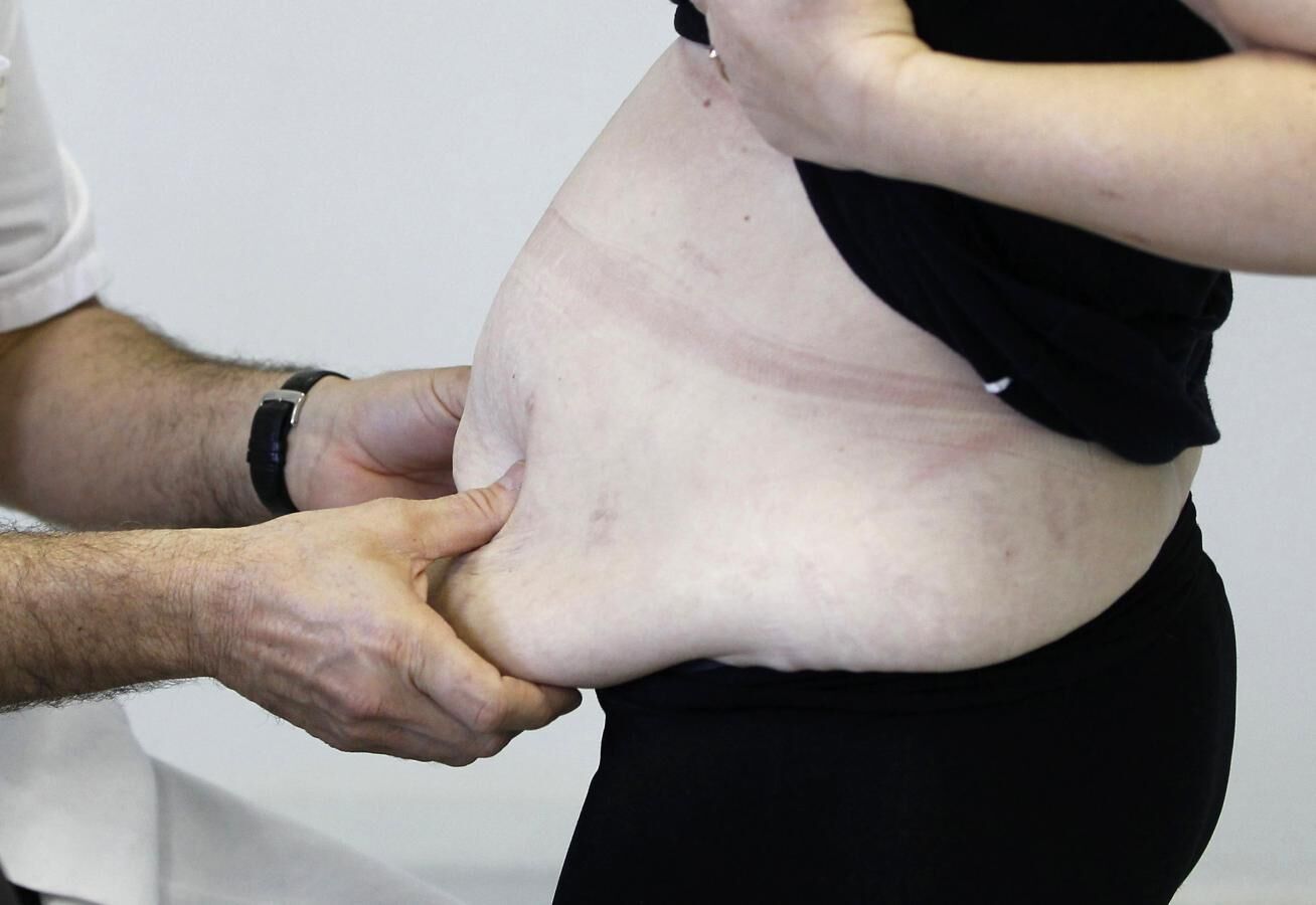 Severe obesity is on the rise in the US